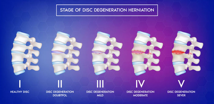 degenerative disc disease causes Ontario