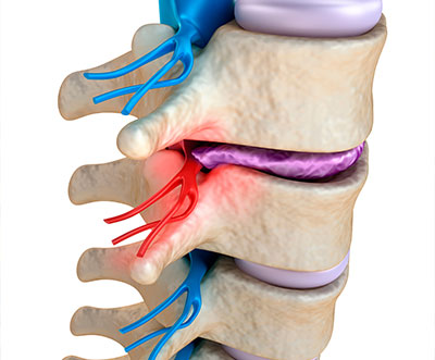spinal decompression for pinched nerve in Ontario