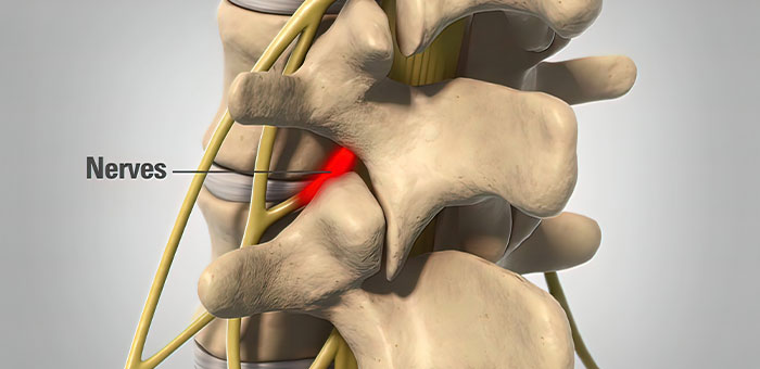pinched nerve treatment in Ontario