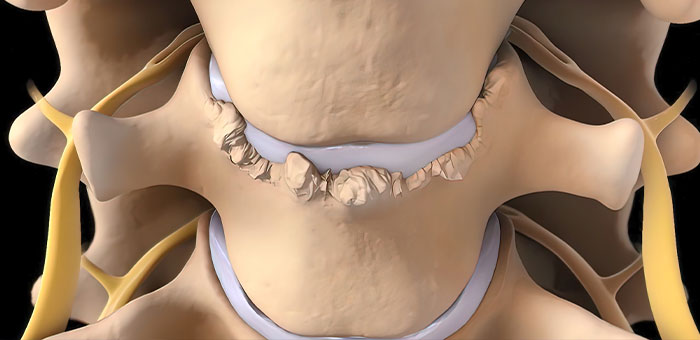 spinal-stenosis treatment in Ontario