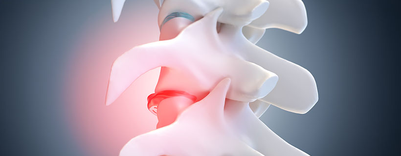 patient needing degenerative disc disease in need of spinal decompression therapy in Ontario