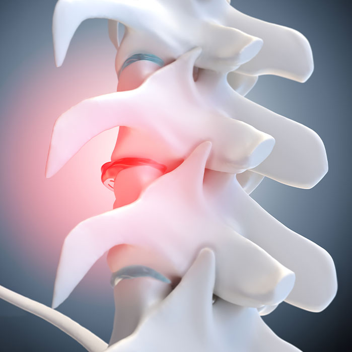 degenerative Disc Disease treatment in Ontario