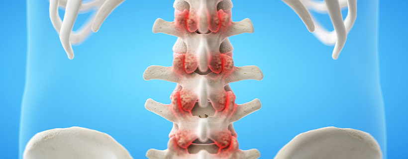 patient needing facet joint syndrome in need of spinal decompression therapy in Ontario