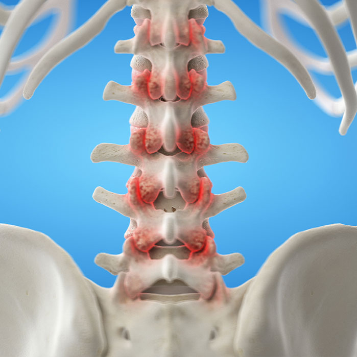 facet Joint Syndrome treatment in Ontario