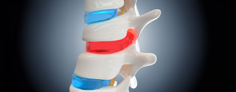 patient needing herniated disc in need of spinal decompression therapy in Ontario