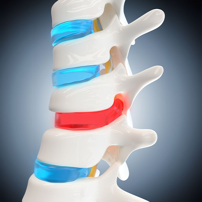 herniated Disc treatment in Ontario