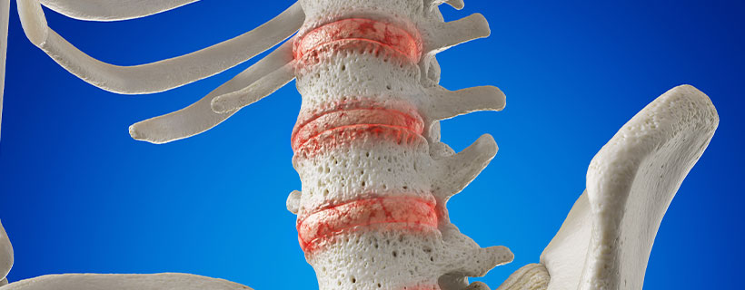 patient needing osteoarthritis in need of spinal decompression therapy in Ontario