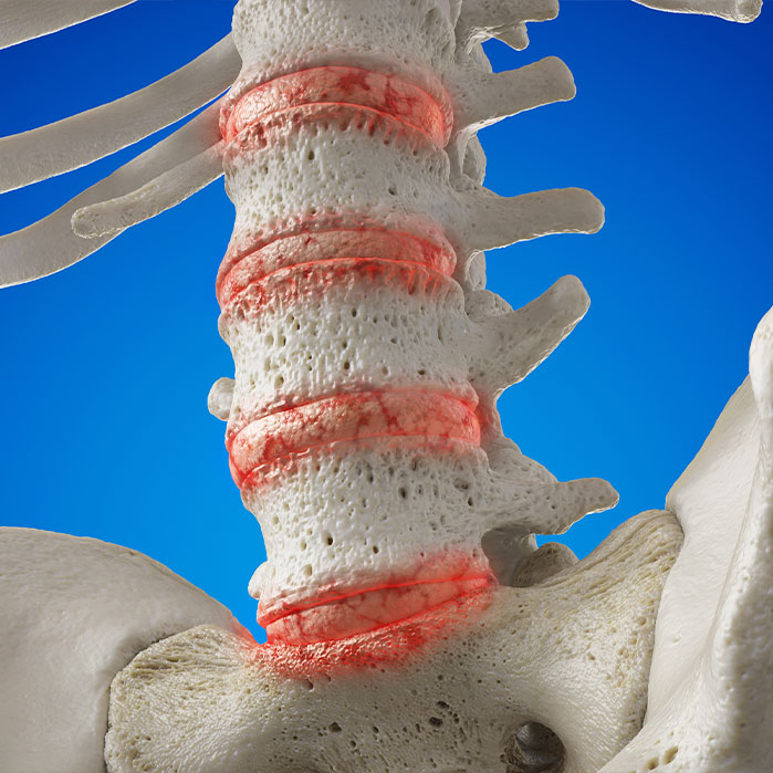 osteoarthritis treatment in Ontario