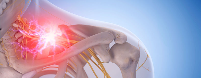 patient needing pinched nerve in need of spinal decompression therapy in Ontario