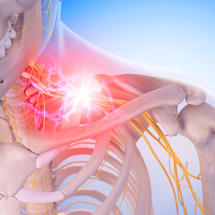 pinched nerve treatment in Ontario