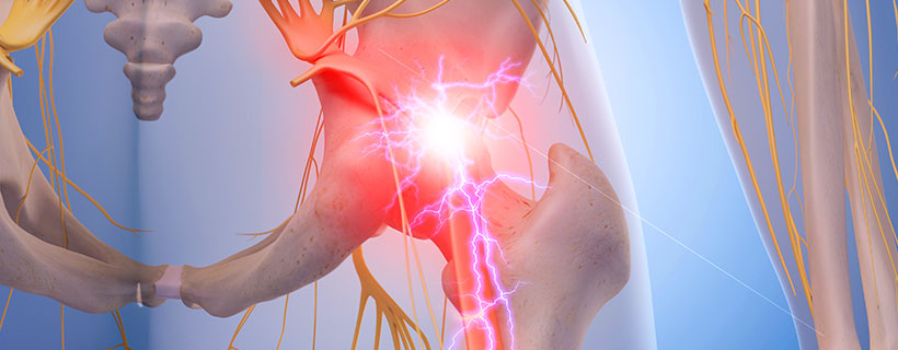 patient needing sciatica in need of spinal decompression therapy in Ontario