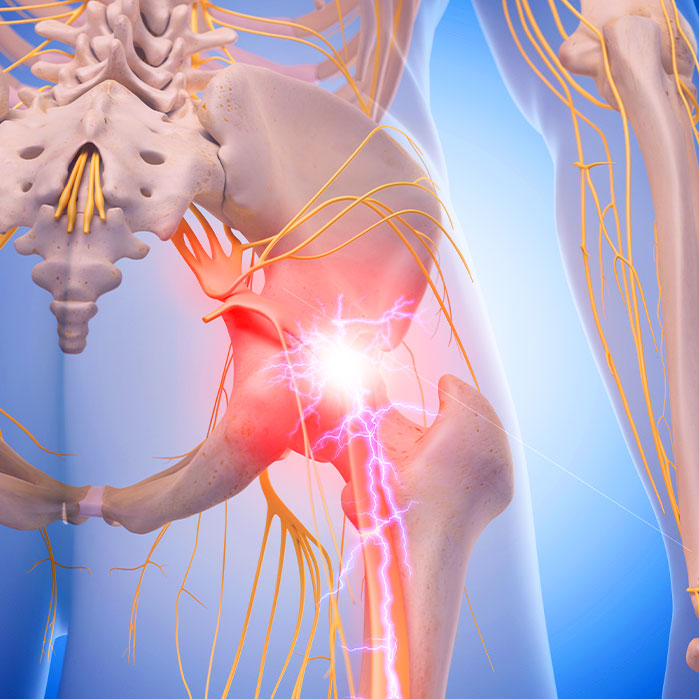 sciatica treatment in Ontario