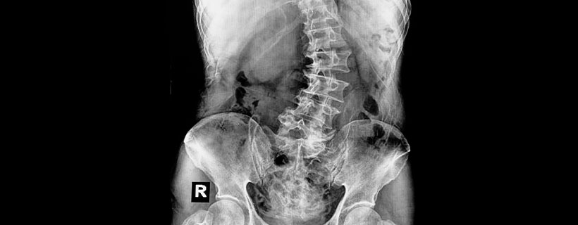 patient needing scoliosis in need of spinal decompression therapy in Ontario