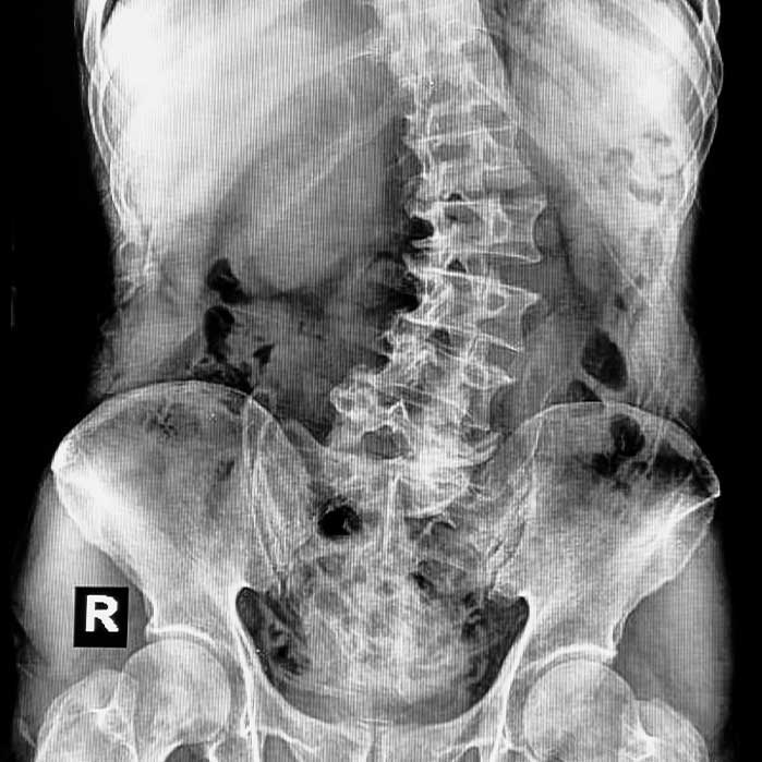 scoliosis treatment in Ontario