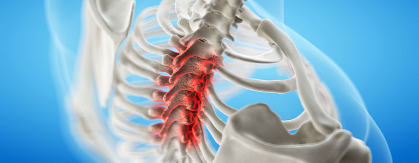 patient needing spinal stenosis in need of spinal decompression therapy in Ontario