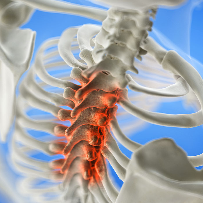 spinal Stenosis treatment in Ontario