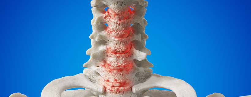 patient needing spondylosis  in need of spinal decompression therapy in Ontario