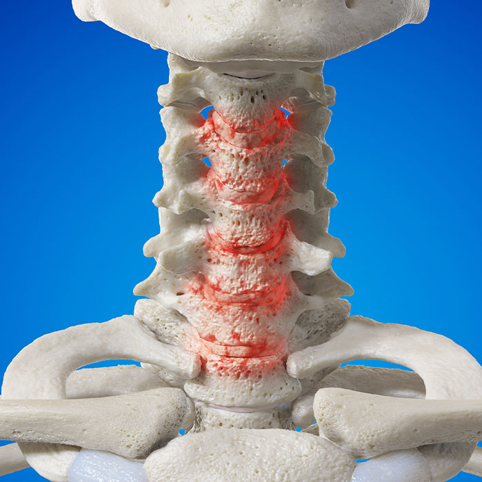 spondylosis treatment in Ontario